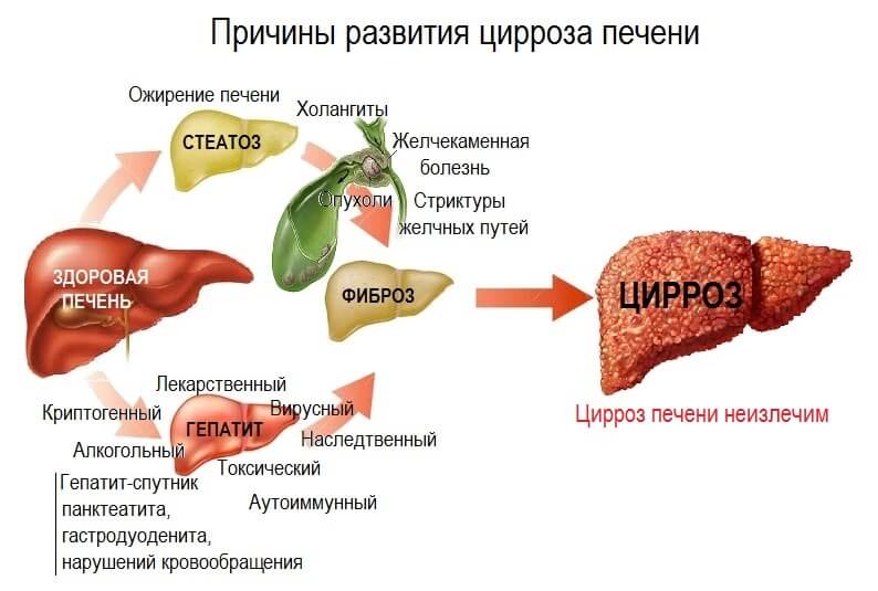 Частые причины развития цирроза печени Причины цирроза печени - схема