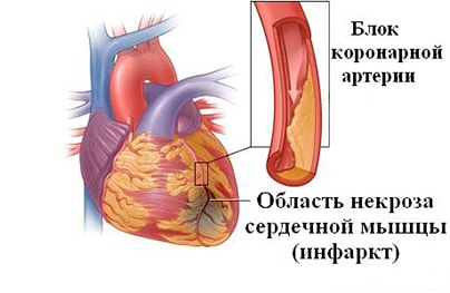 Ишемическая болезнь сердца. Её симптомы, причины, формы.