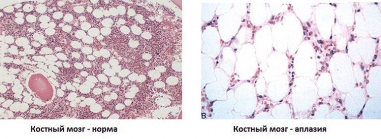 Панмиелофтиз картина крови