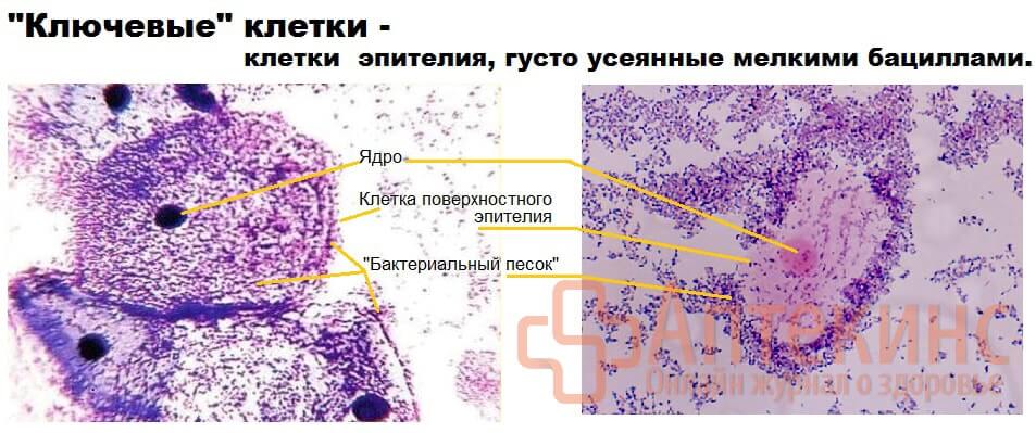 Ключевые клетки в мазке при баквагинозе